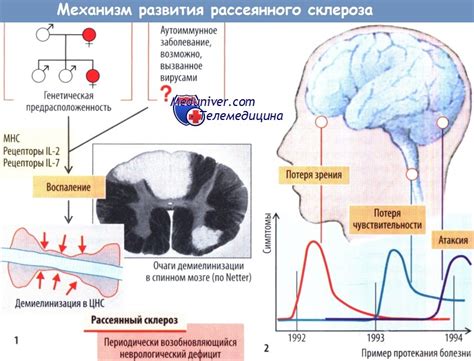 Наследственность при рассеянном склерозе